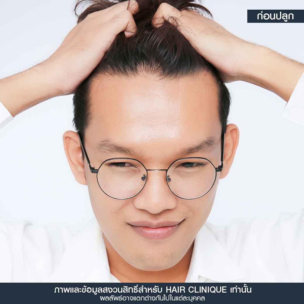 ก่อนปลูกผม,ปลูกผม,ปลูกผม fue,ปลูกผม 2000 กราฟ,รีวิวปลูกผม,ปลูกผมHairClinique,ปลูกผม SLC,รีวิวปลูกผม Hair Clinique