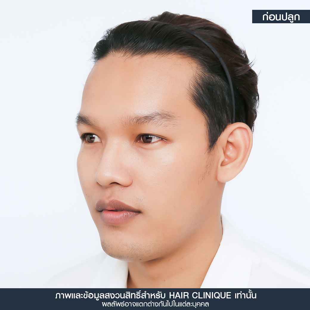 ก่อนปลูกผม,ปลูกผม,ปลูกผม fue,ปลูกผม 2000 กราฟ,รีวิวปลูกผม,ปลูกผมHairClinique,ปลูกผม SLC,รีวิวปลูกผม Hair Clinique