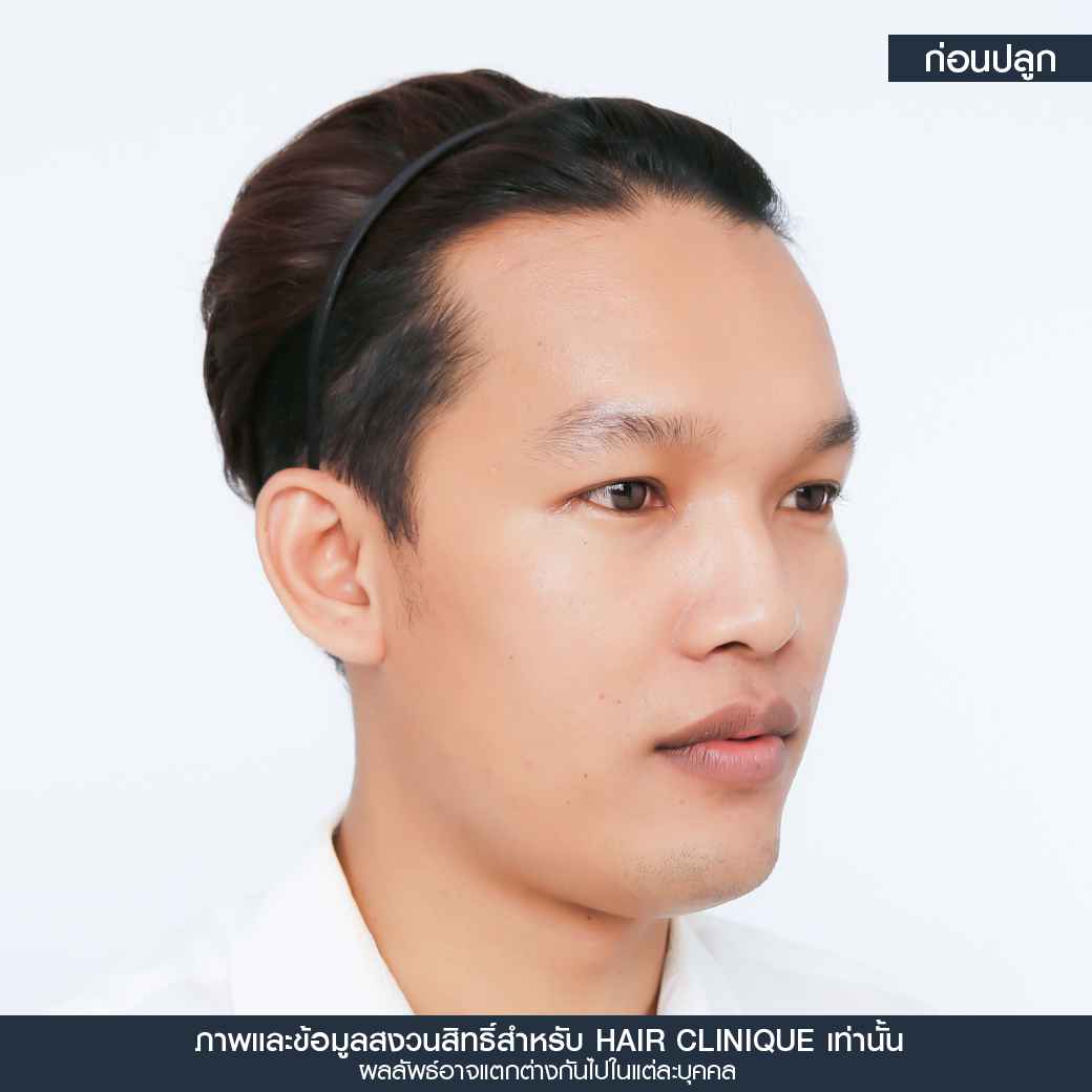 ก่อนปลูกผม,ปลูกผม,ปลูกผม fue,ปลูกผม 2000 กราฟ,รีวิวปลูกผม,ปลูกผมHairClinique,ปลูกผม SLC,รีวิวปลูกผม Hair Clinique