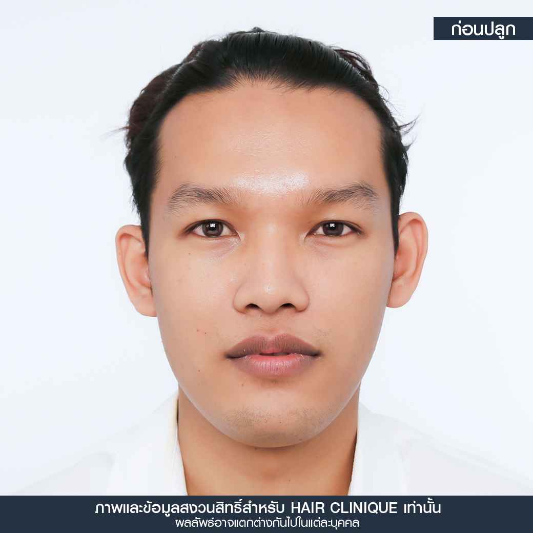 ก่อนปลูกผม,ปลูกผม,ปลูกผม fue,ปลูกผม 2000 กราฟ,รีวิวปลูกผม,ปลูกผมHairClinique,ปลูกผม SLC,รีวิวปลูกผม Hair Clinique