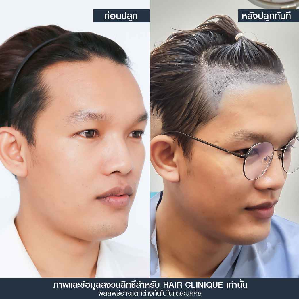 หลังปลูกผมทันที,ปลูกผม,ปลูกผม fue,ปลูกผม 2000 กราฟ,รีวิวปลูกผม,ปลูกผมHairClinique,ปลูกผม SLC,รีวิวปลูกผม Hair Clinique