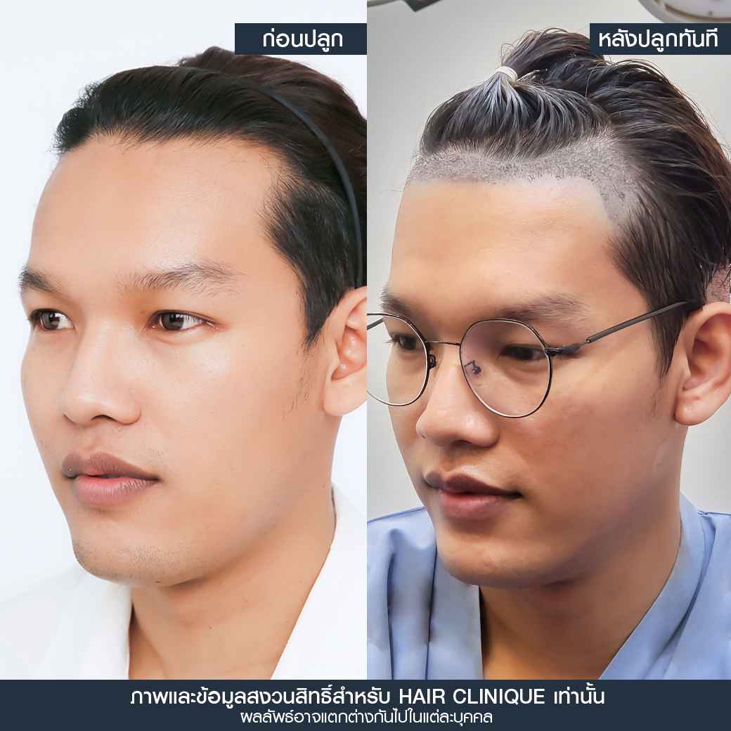 หลังปลูกผมทันที,ปลูกผม,ปลูกผม fue,ปลูกผม 2000 กราฟ,รีวิวปลูกผม,ปลูกผมHairClinique,ปลูกผม SLC,รีวิวปลูกผม Hair Clinique