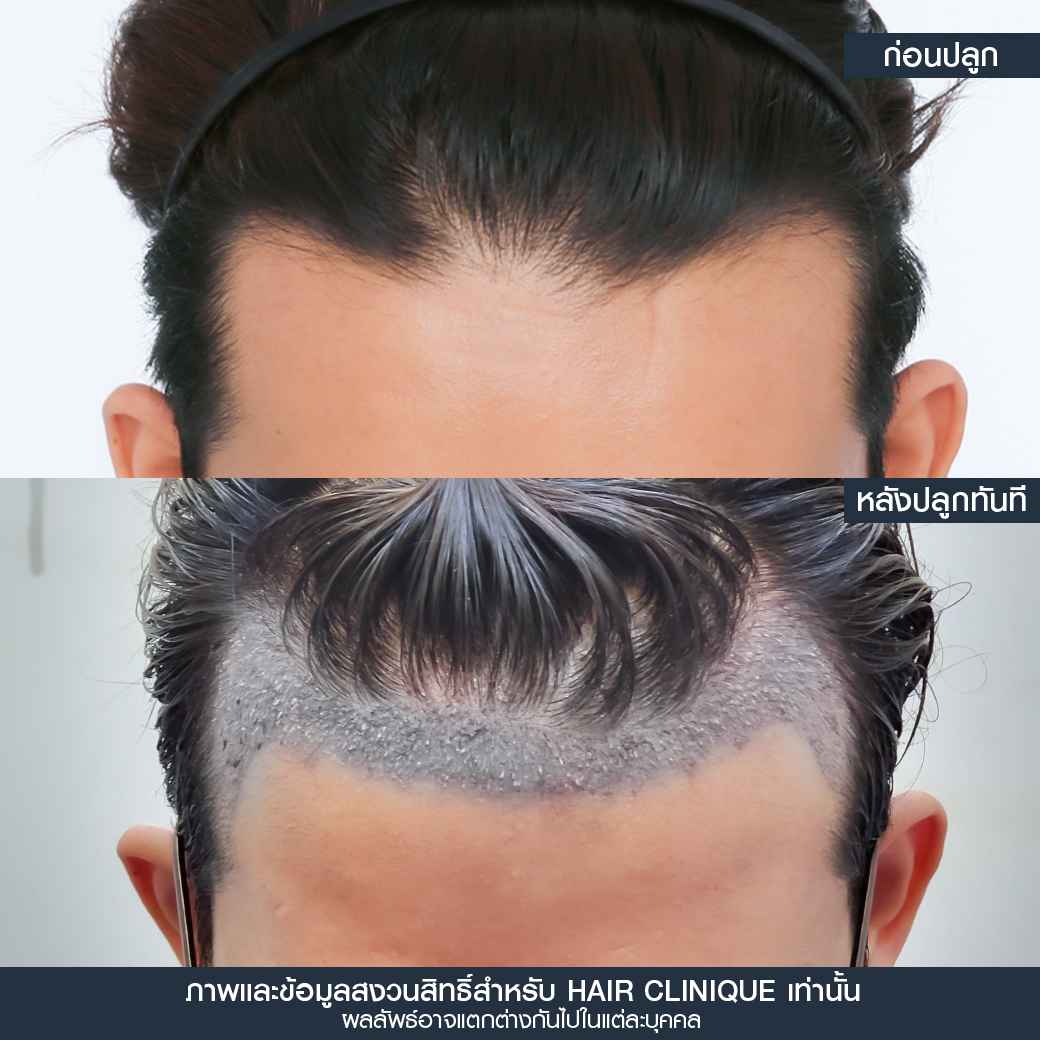 หลังปลูกผมทันที,ปลูกผม,ปลูกผม fue,ปลูกผม 2000 กราฟ,รีวิวปลูกผม,ปลูกผมHairClinique,ปลูกผม SLC,รีวิวปลูกผม Hair Clinique