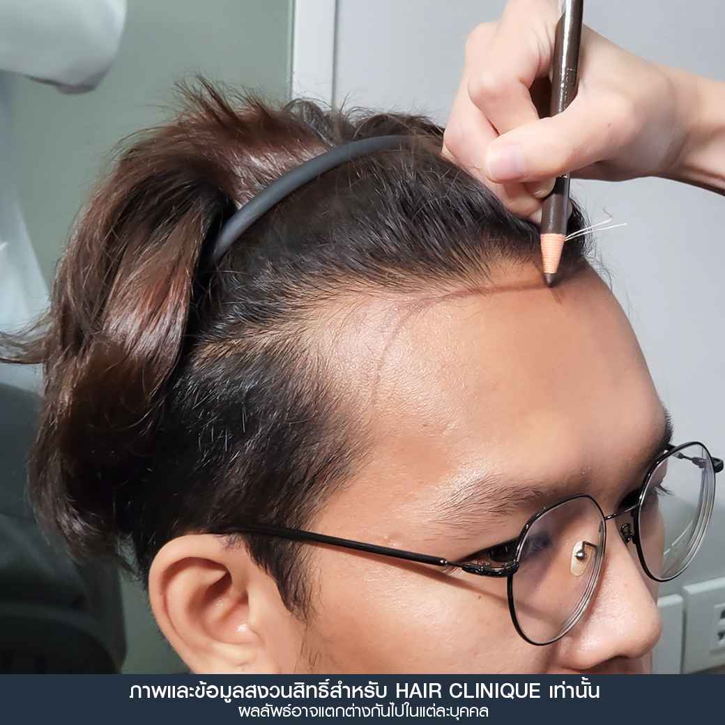 ปลูกผม,ปลูกผม fue,ปลูกผม 2000 กราฟ,รีวิวปลูกผม,ปลูกผมHairClinique,ปลูกผม SLC,รีวิวปลูกผม Hair Clinique