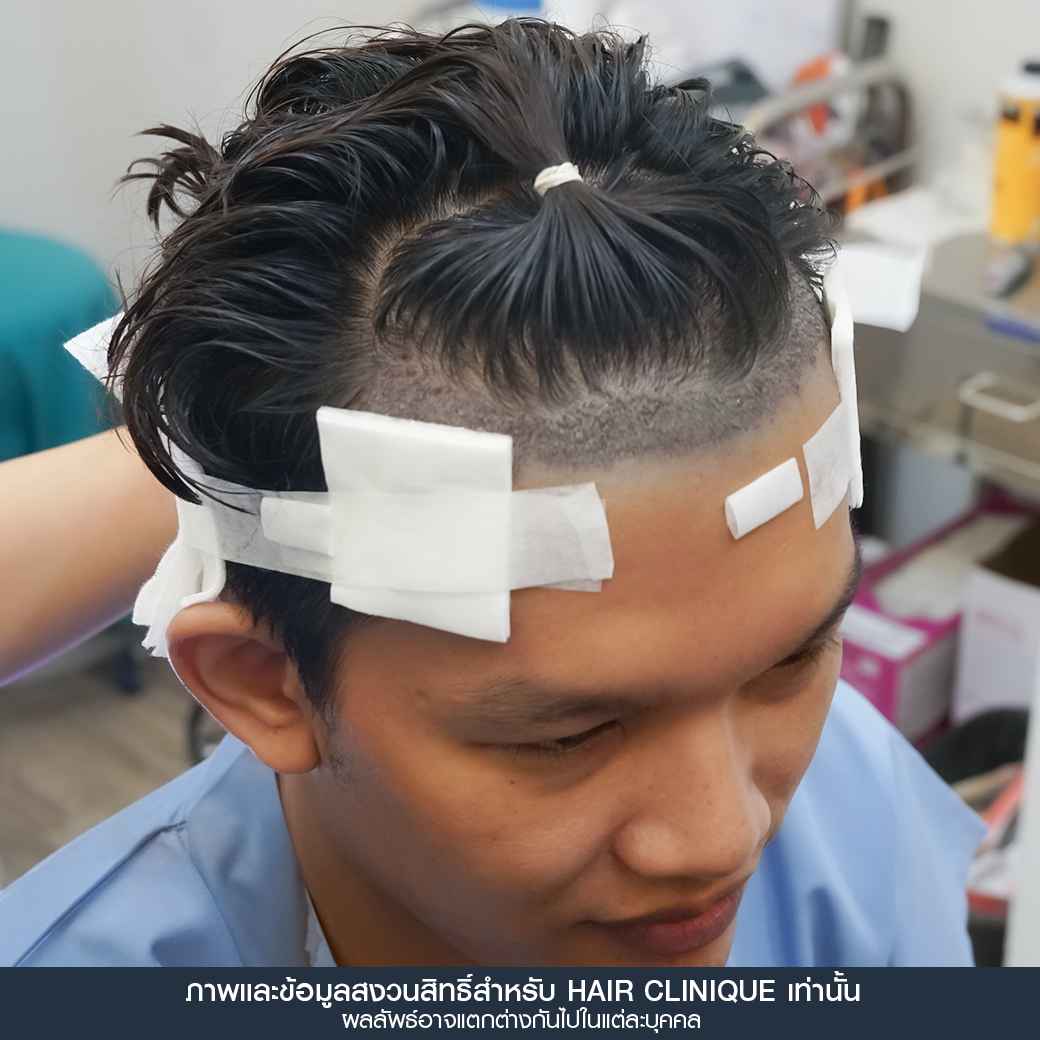 หลังปลูกผมทันที,ปลูกผม,ปลูกผม fue,ปลูกผม 2000 กราฟ,รีวิวปลูกผม,ปลูกผมHairClinique,ปลูกผม SLC,รีวิวปลูกผม Hair Clinique