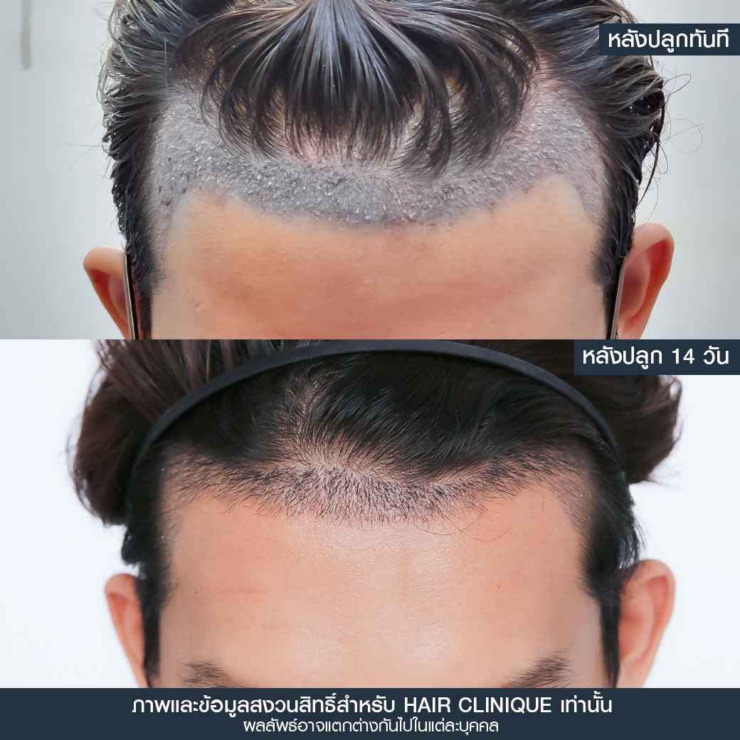 หลังปลูกผม14วัน,ปลูกผม,ปลูกผม fue,ปลูกผม 2000 กราฟ,รีวิวปลูกผม,ปลูกผมHairClinique,ปลูกผม SLC,รีวิวปลูกผม Hair Clinique