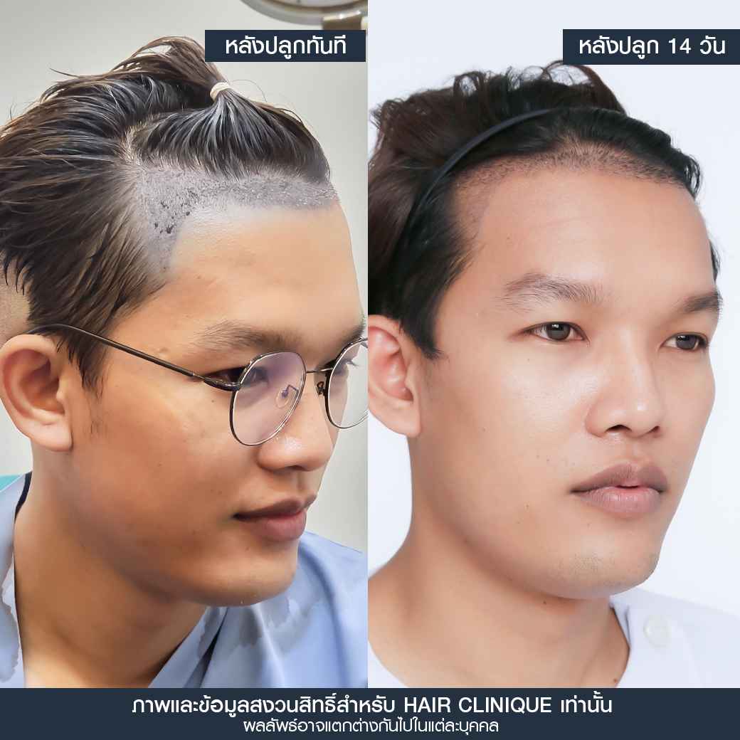 หลังปลูกผม14วัน,ปลูกผม,ปลูกผม fue,ปลูกผม 2000 กราฟ,รีวิวปลูกผม,ปลูกผมHairClinique,ปลูกผม SLC,รีวิวปลูกผม Hair Clinique