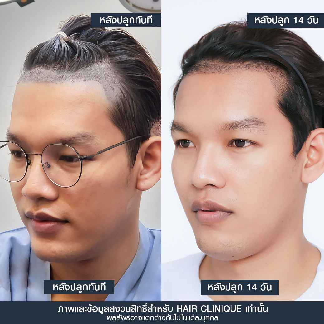 หลังปลูกผม14วัน,ปลูกผม,ปลูกผม fue,ปลูกผม 2000 กราฟ,รีวิวปลูกผม,ปลูกผมHairClinique,ปลูกผม SLC,รีวิวปลูกผม Hair Clinique