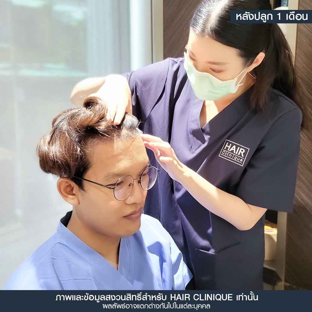 หลังปลูกผม1เดือน,ปลูกผม,ปลูกผม fue,ปลูกผม 2000 กราฟ,รีวิวปลูกผม,ปลูกผมHairClinique,ปลูกผม SLC,รีวิวปลูกผม Hair Clinique