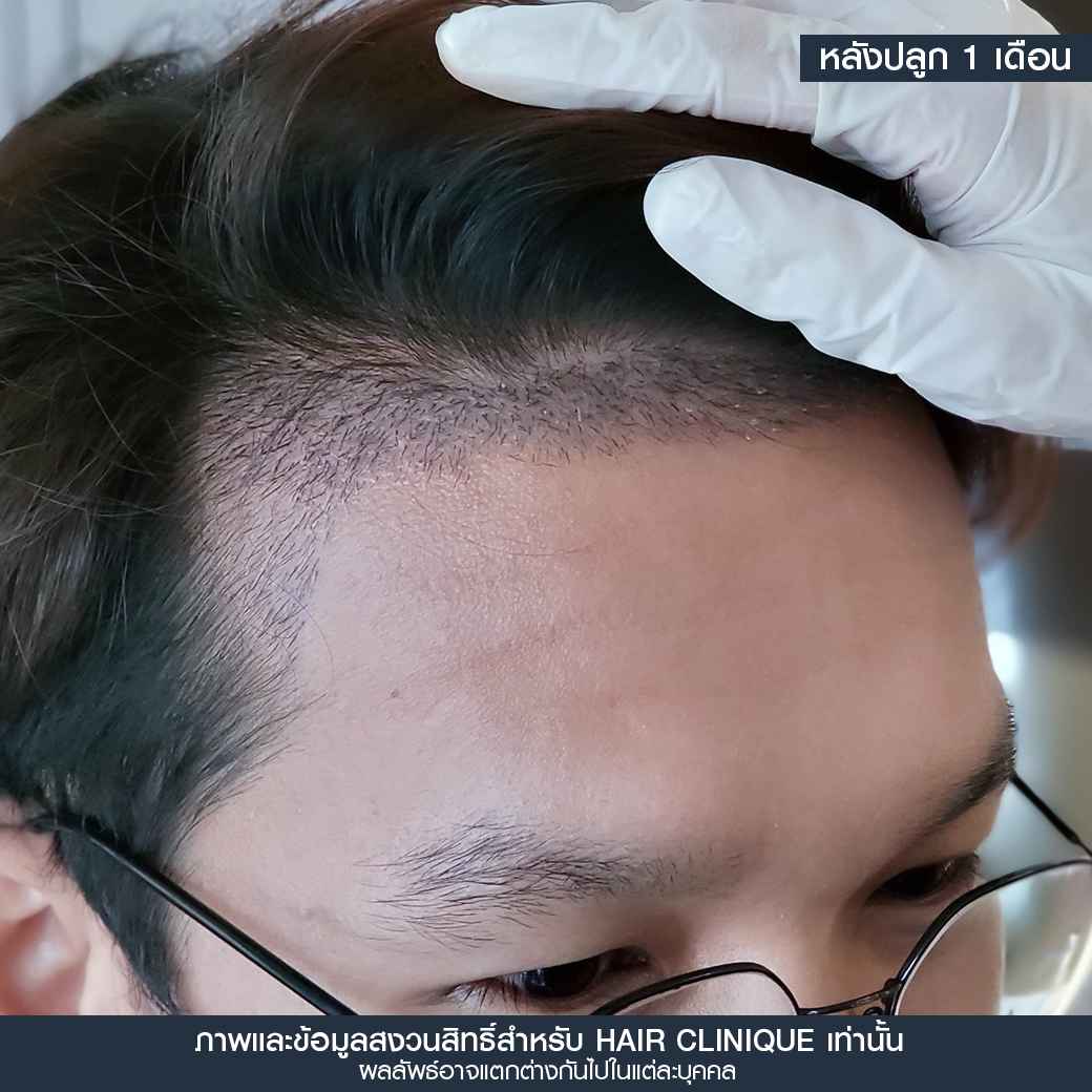 หลังปลูกผม1เดือน,ปลูกผม,ปลูกผม fue,ปลูกผม 2000 กราฟ,รีวิวปลูกผม,ปลูกผมHairClinique,ปลูกผม SLC,รีวิวปลูกผม Hair Clinique