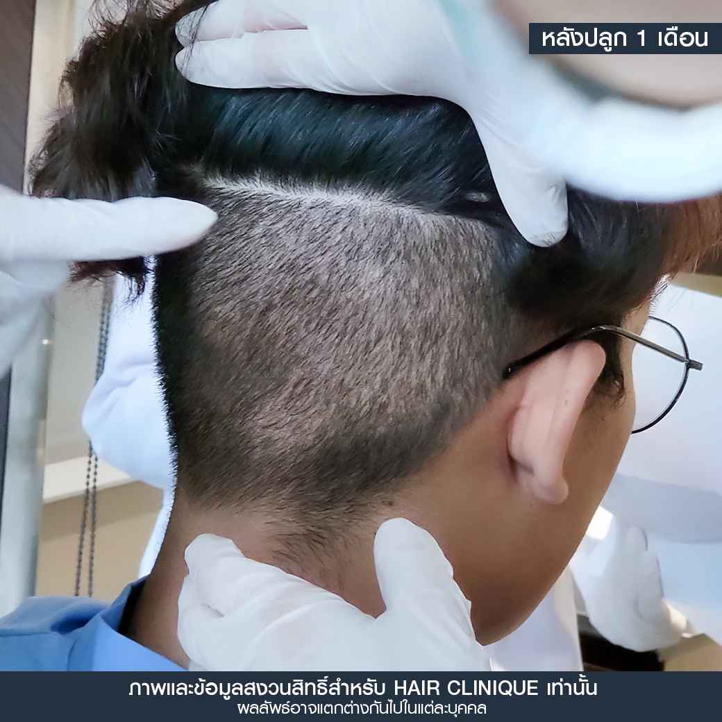 หลังปลูกผม1เดือน,ปลูกผม,ปลูกผม fue,ปลูกผม 2000 กราฟ,รีวิวปลูกผม,ปลูกผมHairClinique,ปลูกผม SLC,รีวิวปลูกผม Hair Clinique