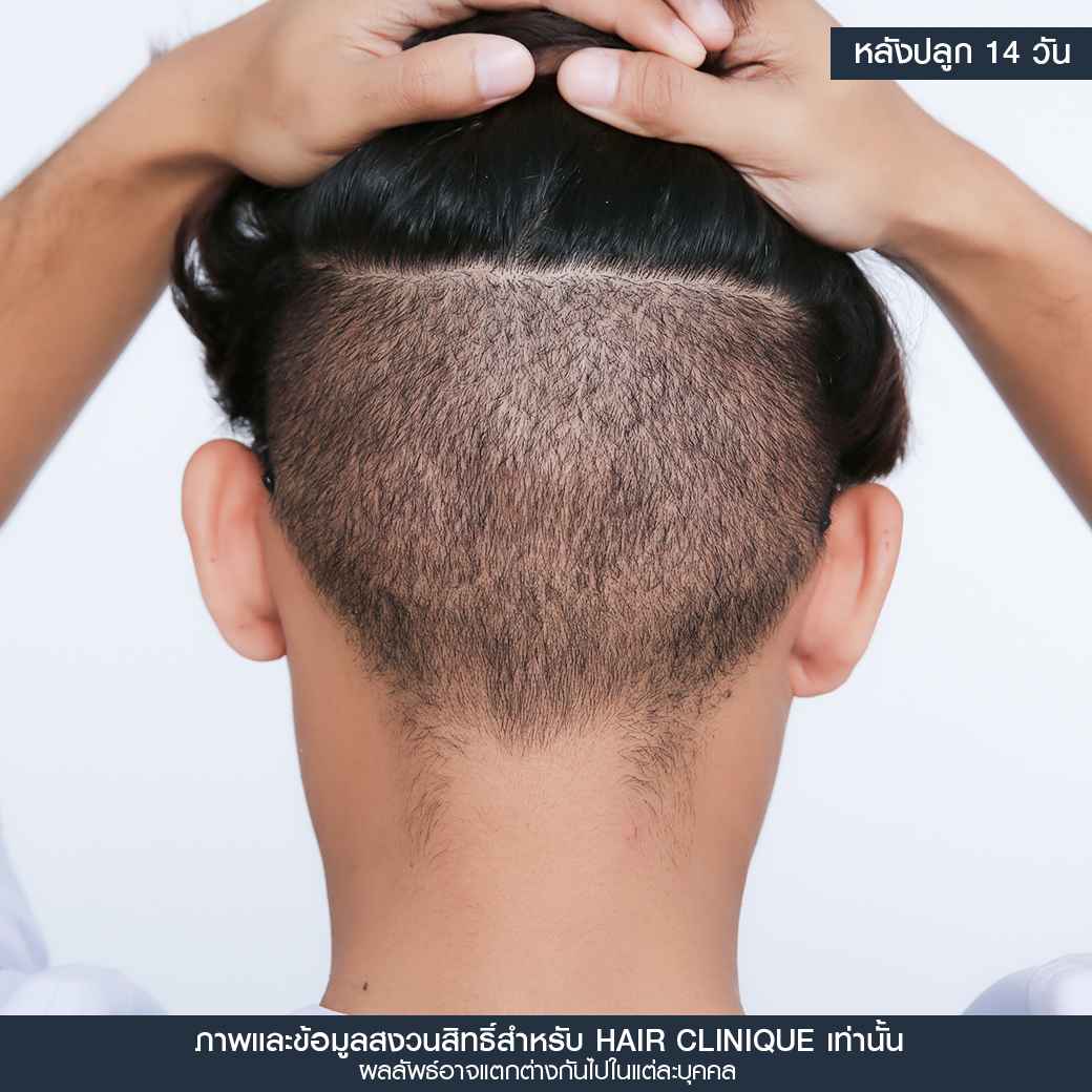 หลังปลูกผม14วัน,ปลูกผม,ปลูกผม fue,ปลูกผม 2000 กราฟ,รีวิวปลูกผม,ปลูกผมHairClinique,ปลูกผม SLC,รีวิวปลูกผม Hair Clinique