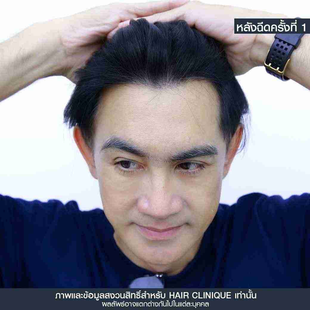 หลังฉีดครั้งที่1 Hair formula shot,วิตามินบำรุงผม,รากผมไม่แข็งแรง,ปลูกผมไม่ผ่าตัด,รีวิว exosome hair,exosome hair,Hair formula shot™,Hair formula shot,รีวิว Hair formula shot