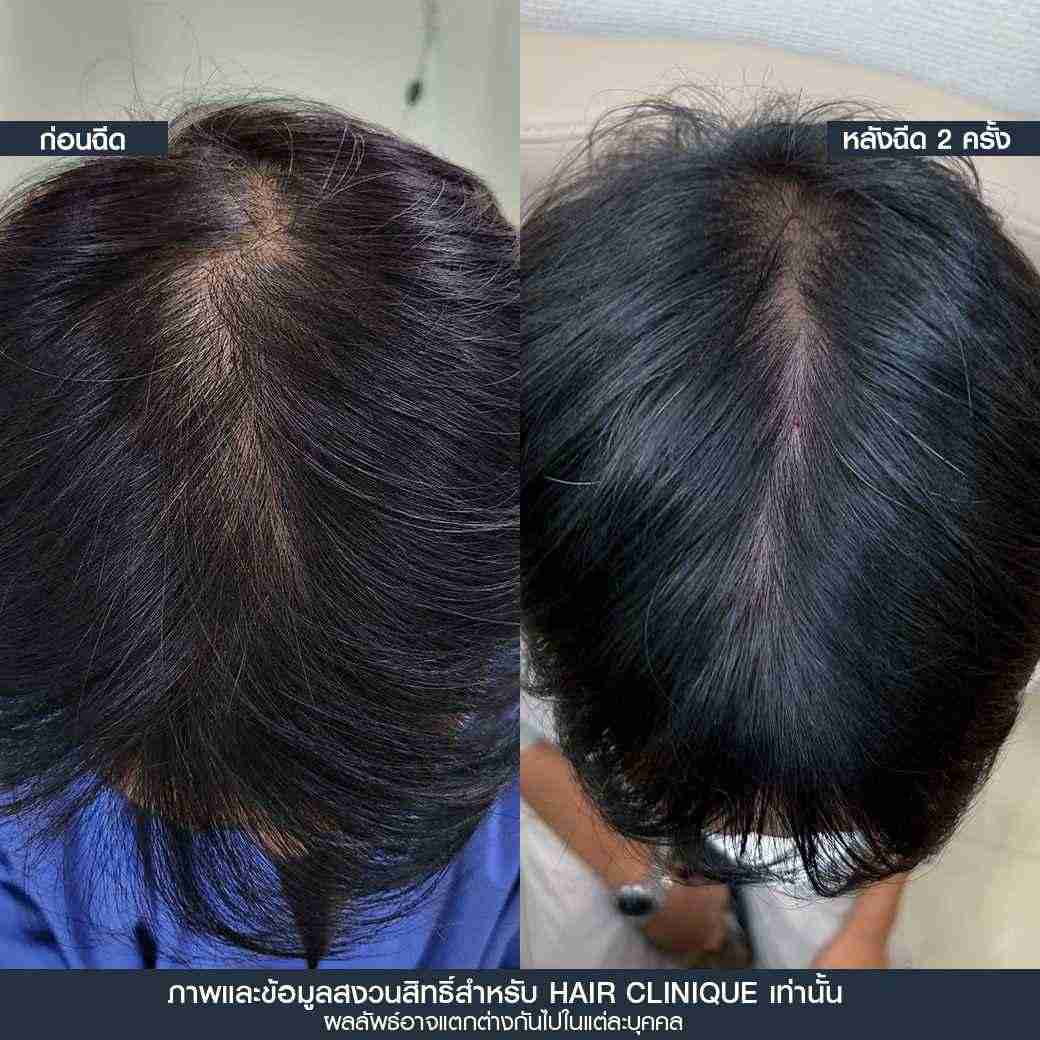 รากผมไม่แข็งแรง,รากผมฝ่อ,รีวิว Hair formula shot,ผมร่วง ผมบาง,แก้ผมร่วง ผมบาง