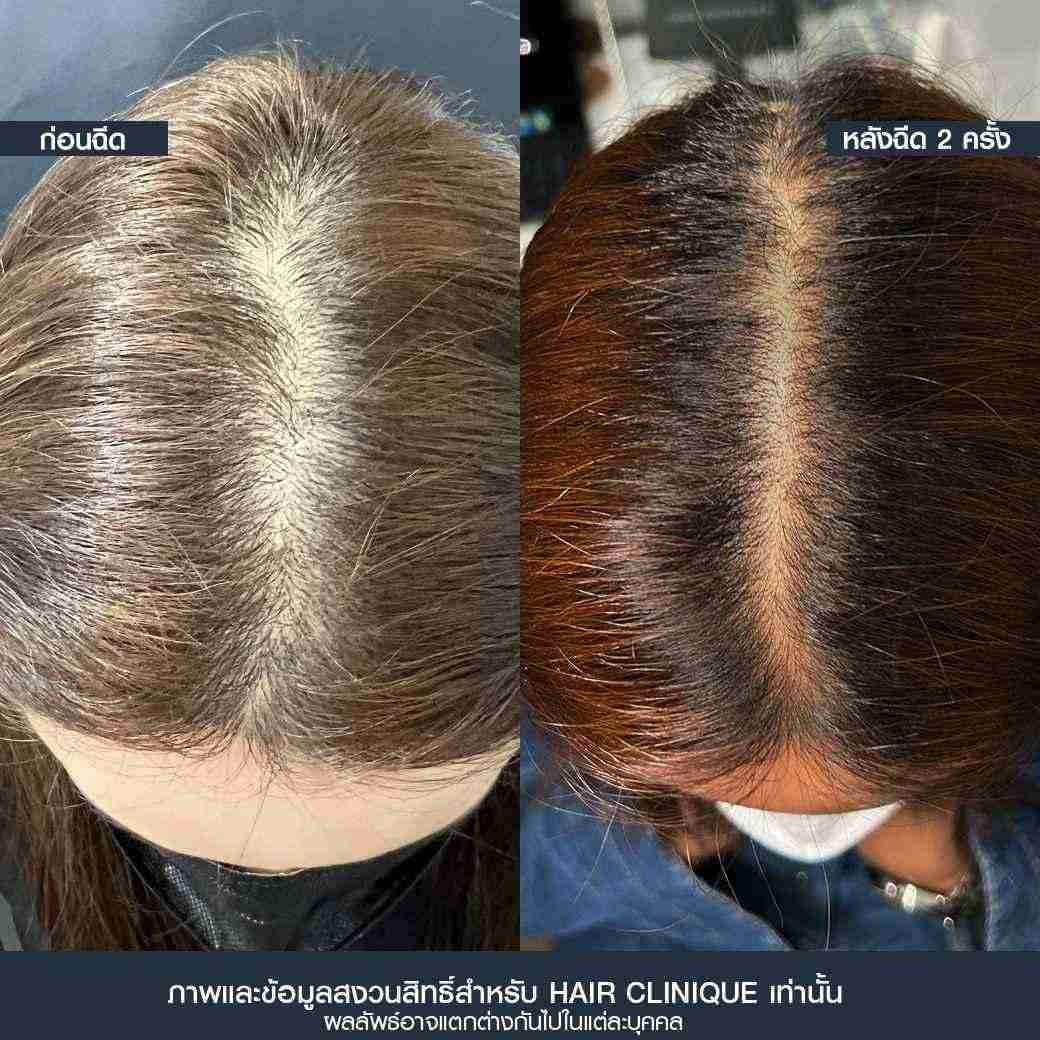 รากผมไม่แข็งแรง,รากผมฝ่อ,รีวิว Hair formula shot,ผมร่วง ผมบาง,แก้ผมร่วง ผมบาง