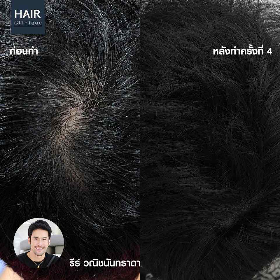 รีวิวปลูกผมไม่ผ่าตัด,Hair formula shot™,ฉีดวิตามินผม,ปลูกผมไม่ผ่าตัด,ปลูกผม Hair formula shot™,ฉีดวิตามินผม Hair formula shot™,รีวิวปลูกผม,รีวิว Hair formula shot™,รีวิว Exosome Hair,รีวิว Exosome,รีวิวปลูกผม Hair formula shot™