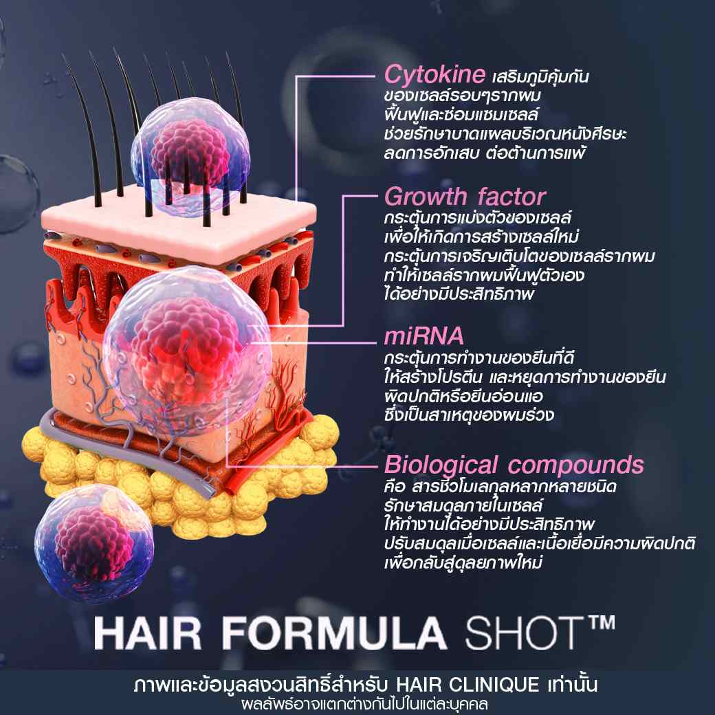 รีวิวปลูกผมไม่ผ่าตัด,Hair formula shot™,ฉีดวิตามินผม,ปลูกผมไม่ผ่าตัด,ปลูกผม Hair formula shot™,ฉีดวิตามินผม Hair formula shot™,รีวิวปลูกผม,รีวิว Hair formula shot™,รีวิว Exosome Hair,รีวิว Exosome,รีวิวปลูกผม Hair formula shot™