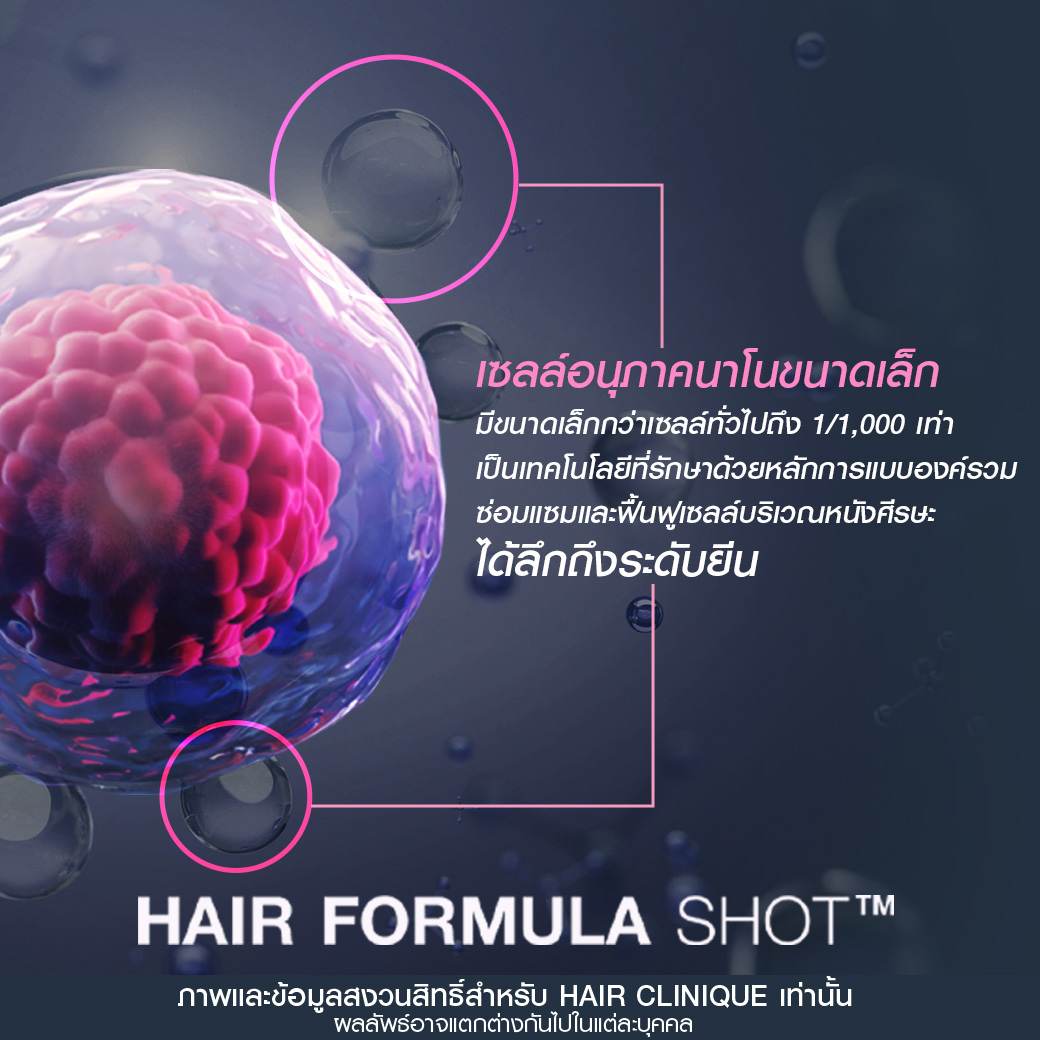 รีวิวปลูกผมไม่ผ่าตัด,Hair formula shot™,ฉีดวิตามินผม,ปลูกผมไม่ผ่าตัด,ปลูกผม Hair formula shot™,ฉีดวิตามินผม Hair formula shot™,รีวิวปลูกผม,รีวิว Hair formula shot™,รีวิว Exosome Hair,รีวิว Exosome,รีวิวปลูกผม Hair formula shot™