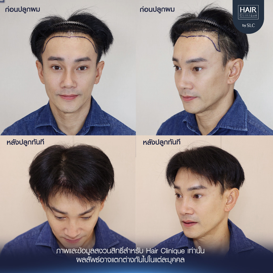 ต๊ะ บอยสเก๊าท์, Long Hair Ready™,ปลูกผม, ปลูกผม Long Hair Ready™