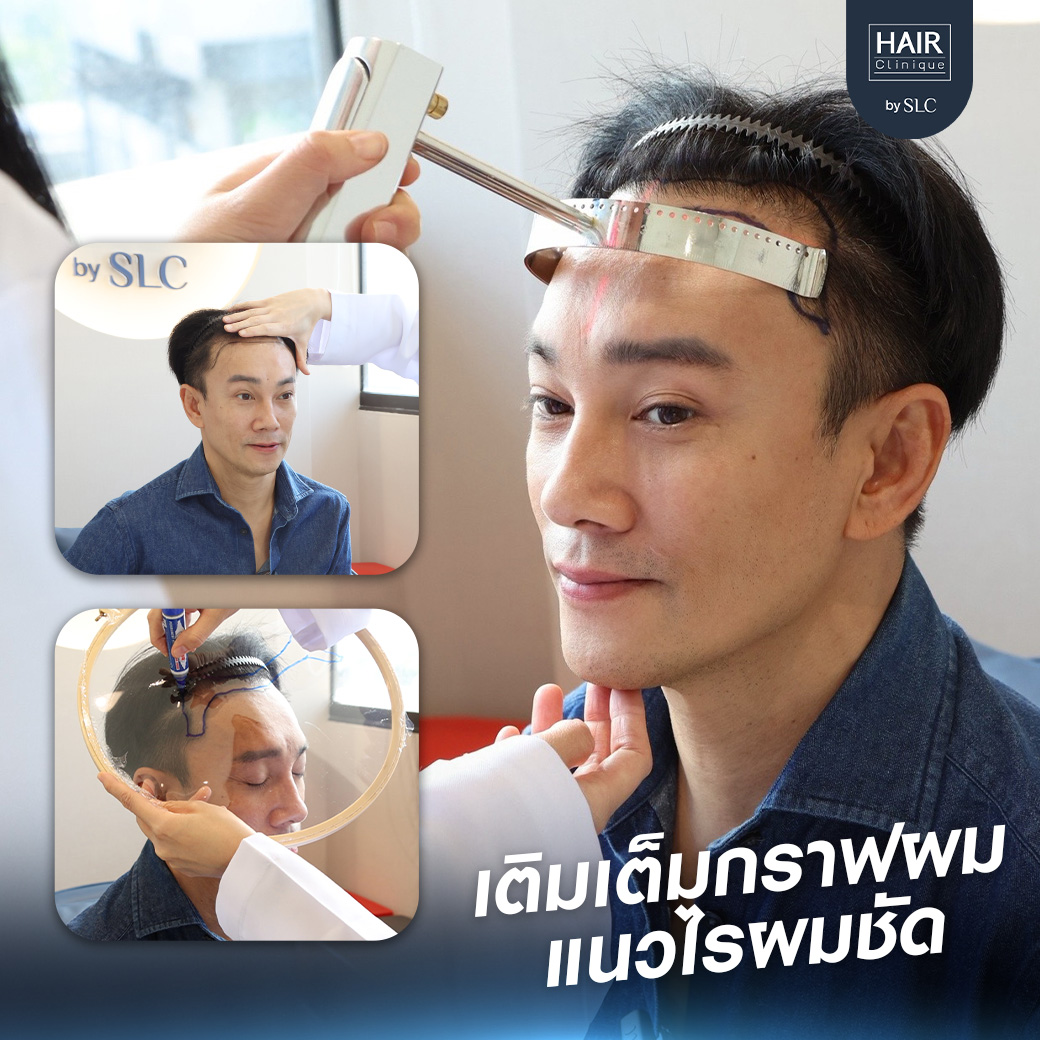 ต๊ะ บอยสเก๊าท์, Long Hair Ready™,ปลูกผม, ปลูกผม Long Hair Ready™