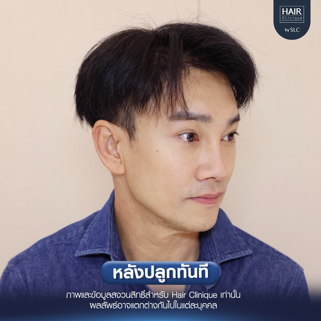 ต๊ะ บอยสเก๊าท์, Long Hair Ready™,ปลูกผม, ปลูกผม Long Hair Ready™