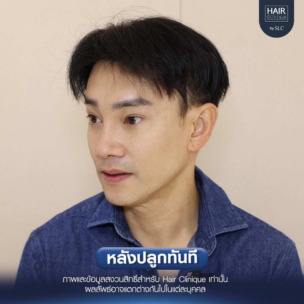 ต๊ะ บอยสเก๊าท์, Long Hair Ready™,ปลูกผม, ปลูกผม Long Hair Ready™