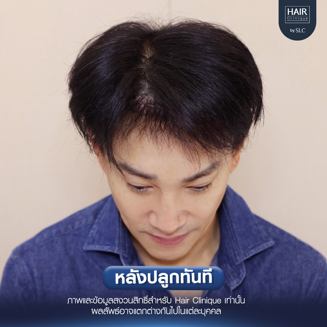 ต๊ะ บอยสเก๊าท์, Long Hair Ready™,ปลูกผม, ปลูกผม Long Hair Ready™