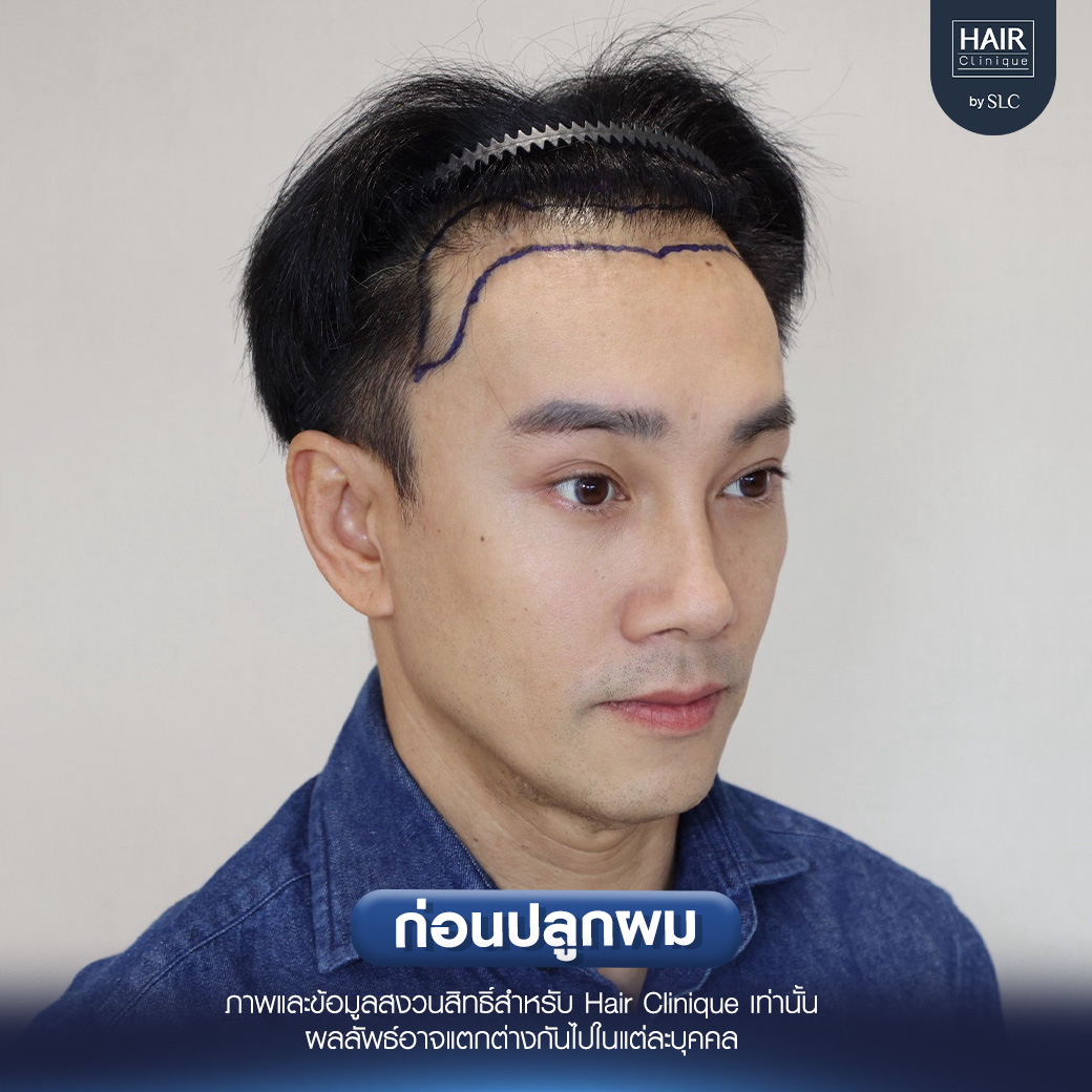 ต๊ะ บอยสเก๊าท์, Long Hair Ready™,ปลูกผม, ปลูกผม Long Hair Ready™