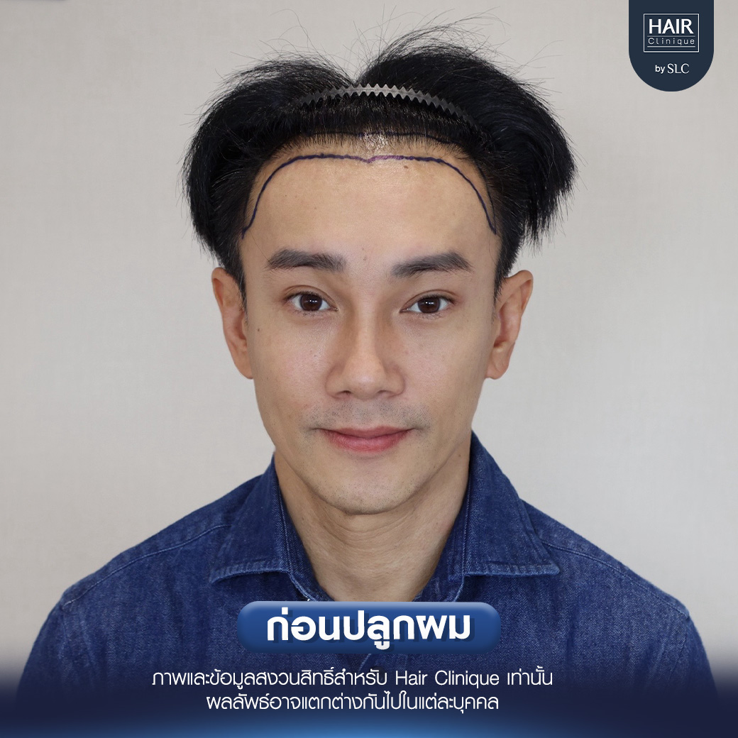 ต๊ะ บอยสเก๊าท์, Long Hair Ready™,ปลูกผม, ปลูกผม Long Hair Ready™