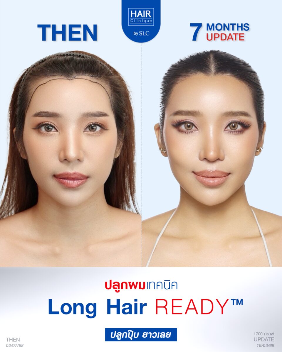 ผลลัพธ์ปลูกผม Long Hair Ready™ หลัง 7 เดือน