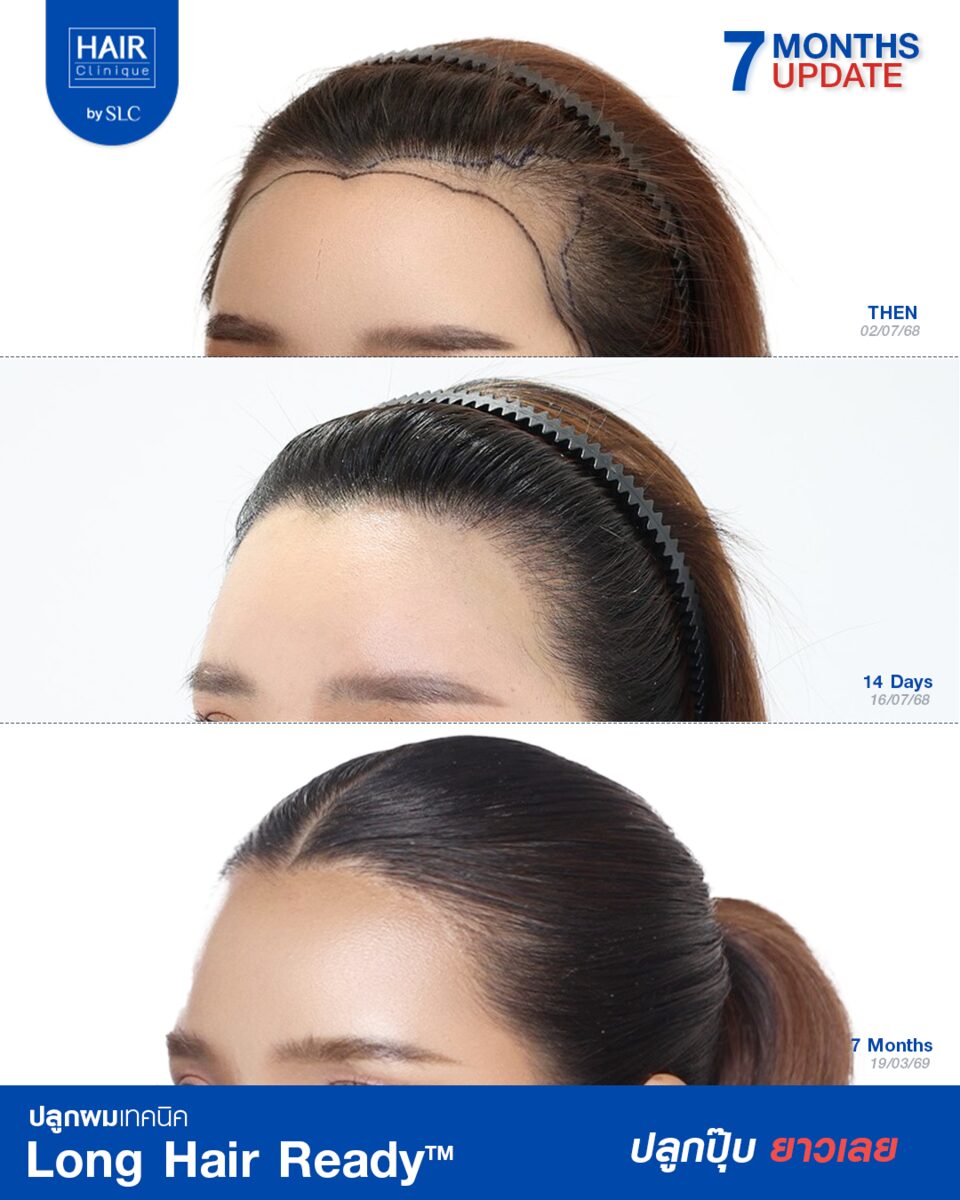 แนวผมก่อนและหลังปลูกผม Long Hair Ready™ 14 วัน และ 7 เดือน