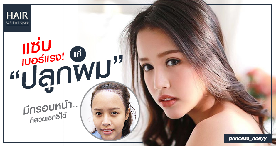 ปลูกผมผู้หญิง ตั้งแต่ผมบางจนผมหนาดกดำ