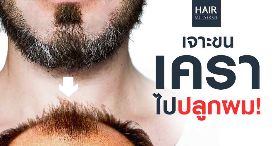 ปลูกผมด้วยขนเคราได้