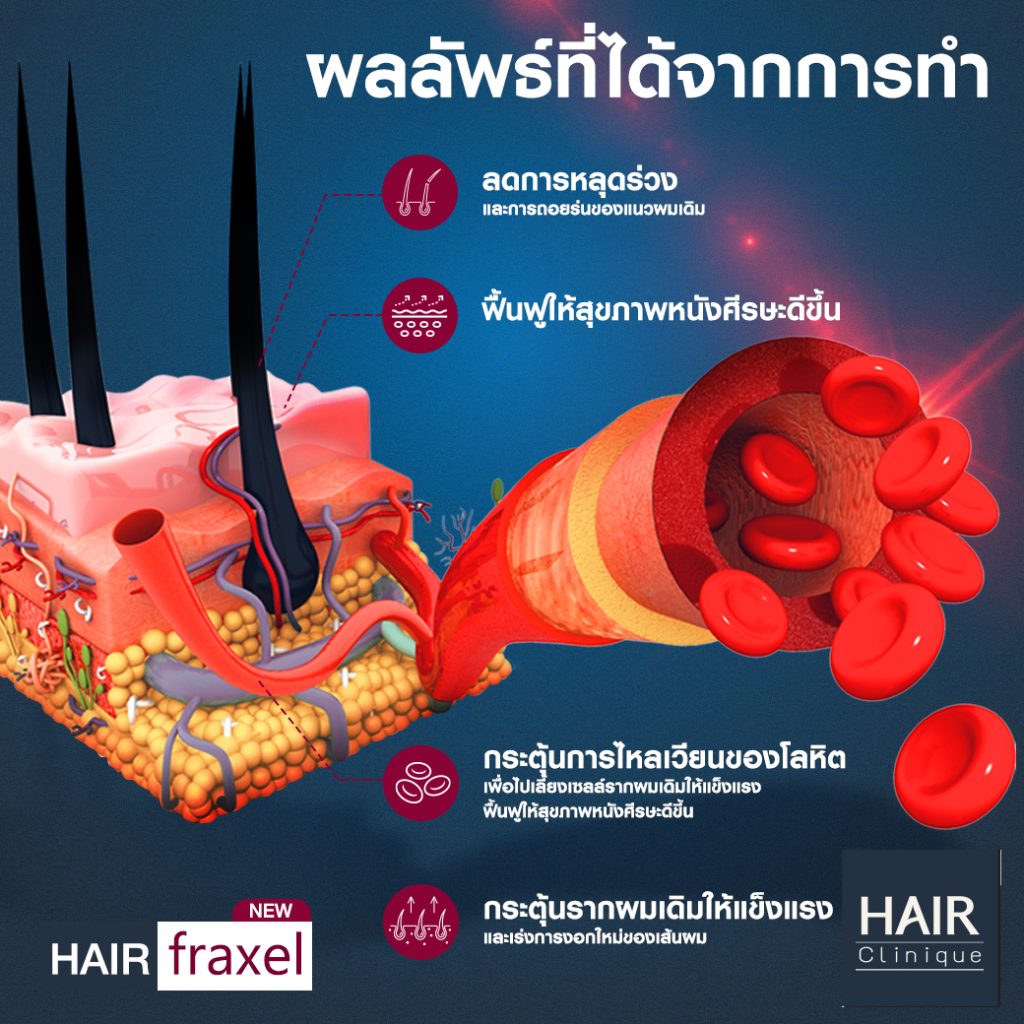 ผลลัพธ์ที่ได้จากการทำ Hair Fraxel เลเซอร์รักษาผมร่วง