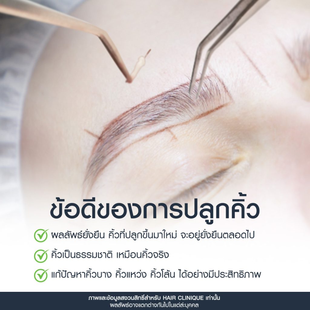 ข้อดีการปลูกคิ้ว
