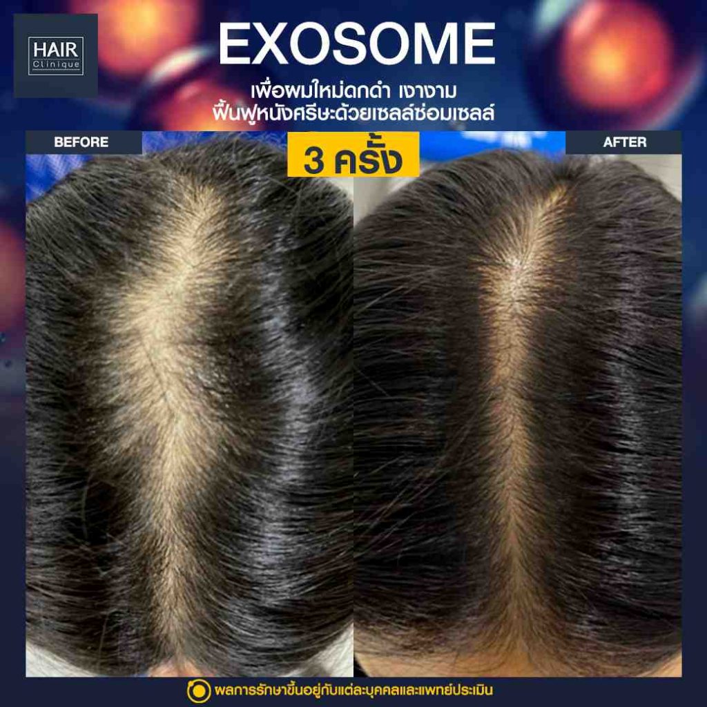 xosome SLC ฉีดวิตามินบำรุงผม รีวิว