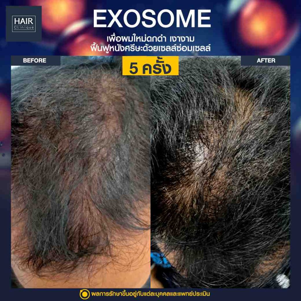 xosome SLC ฉีดวิตามินบำรุงผม รีวิว