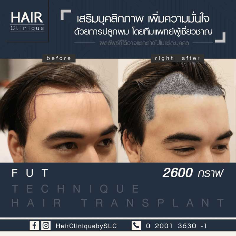รีวิวปลูกผม FUT