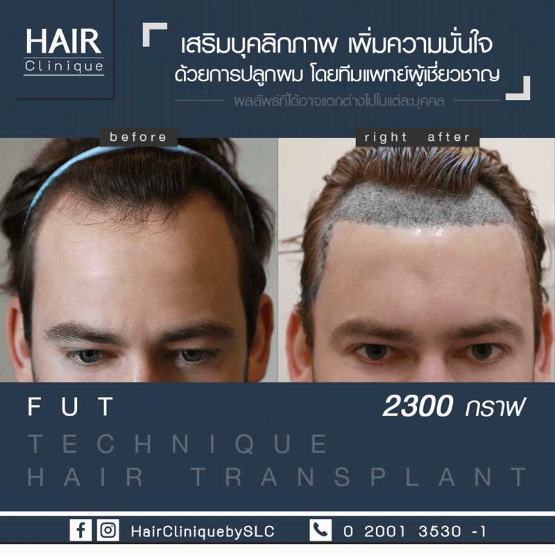 รีวิวปลูกผม FUT