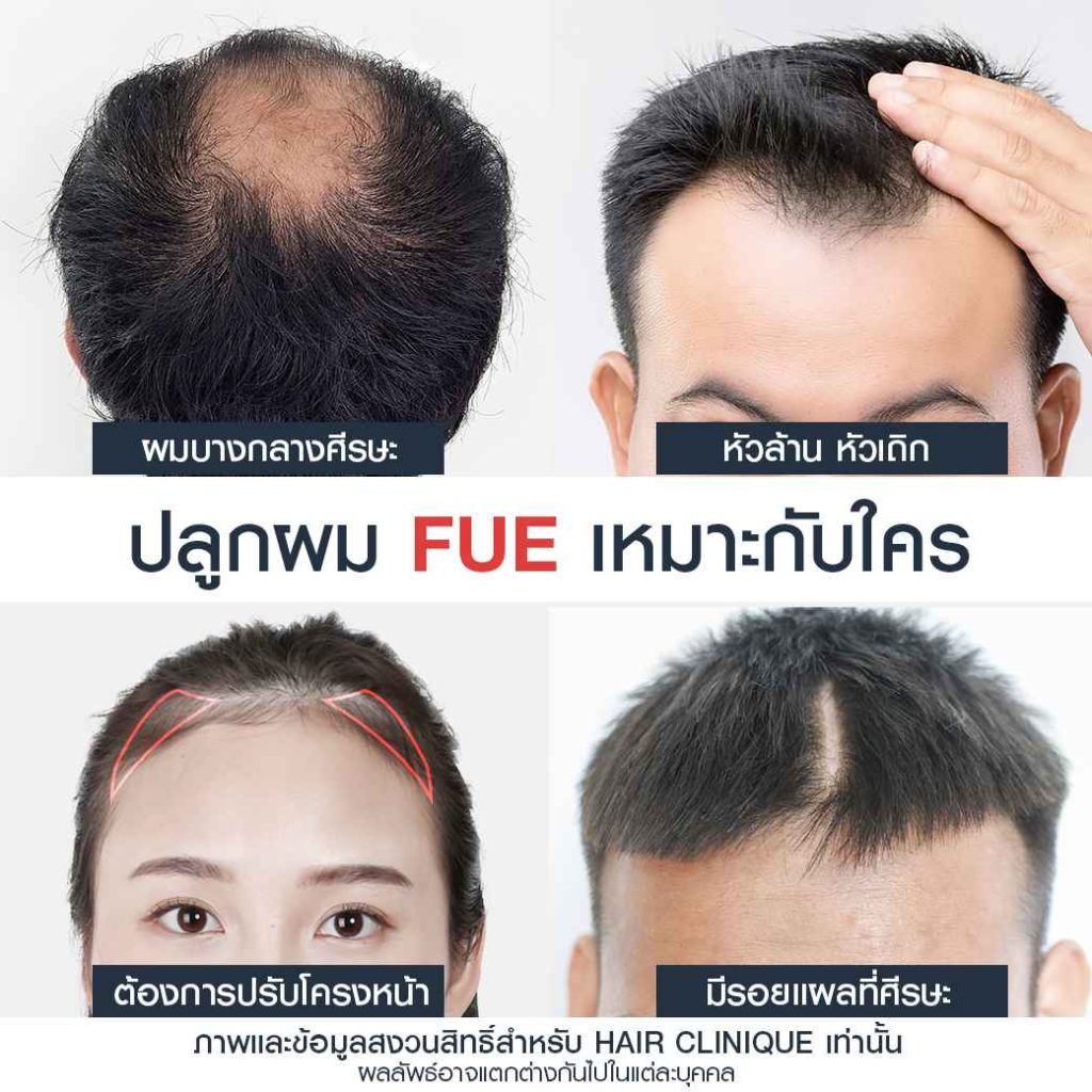 ปลูกผม FUE เหมาะกับใคร?