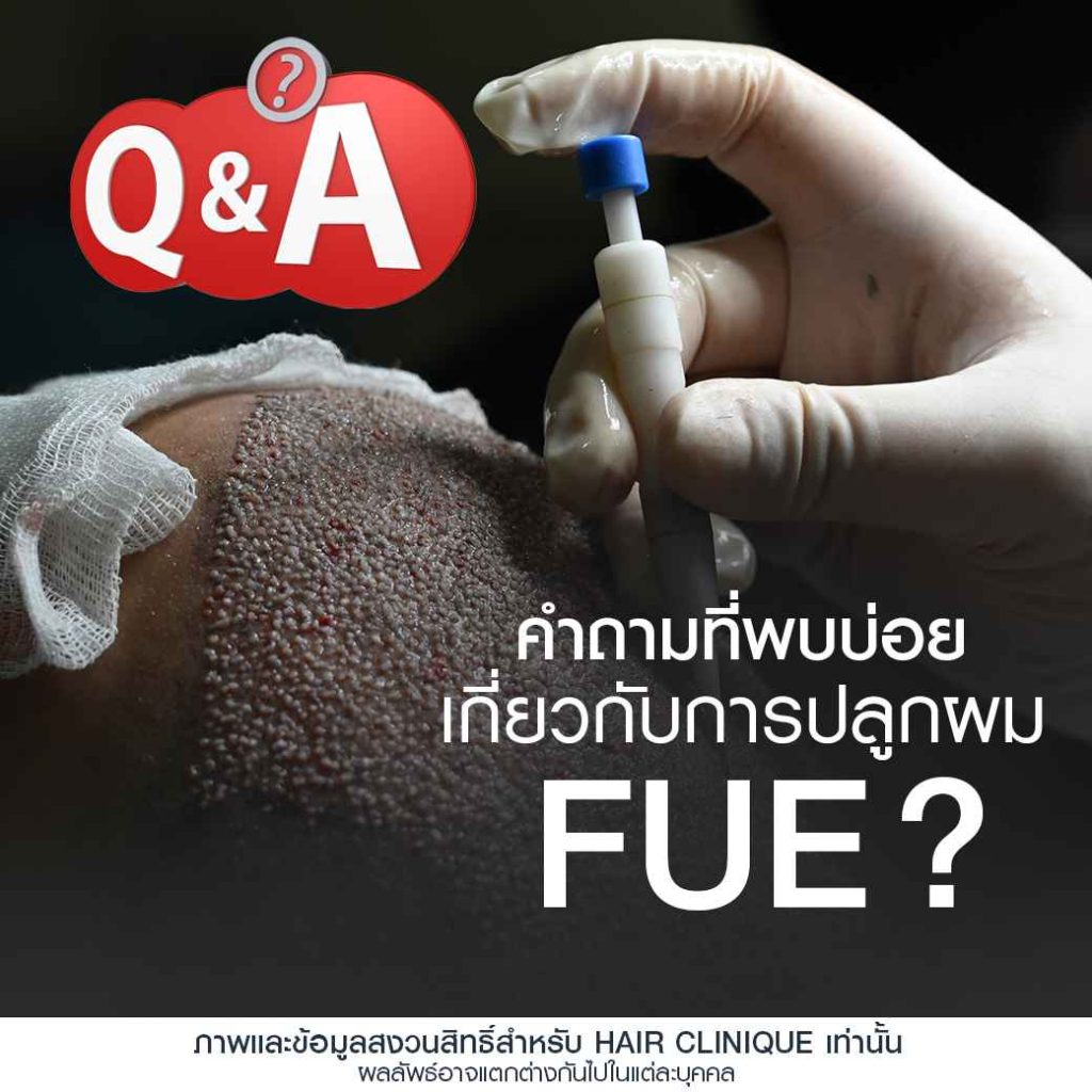 ปลูกผม FUE คุ้มค่าหรือไม่?