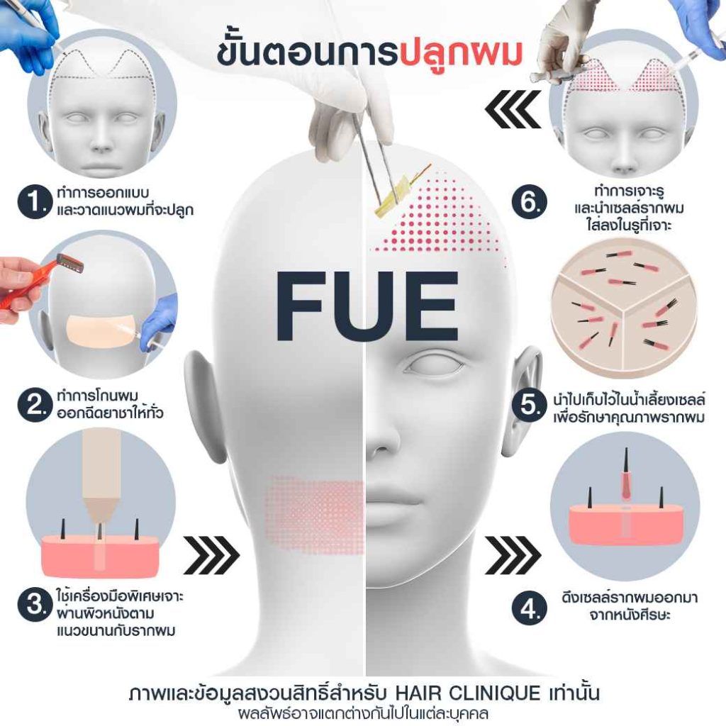 ขั้นตอนการปลูกผม FUE (Follicular Unit Extraction)