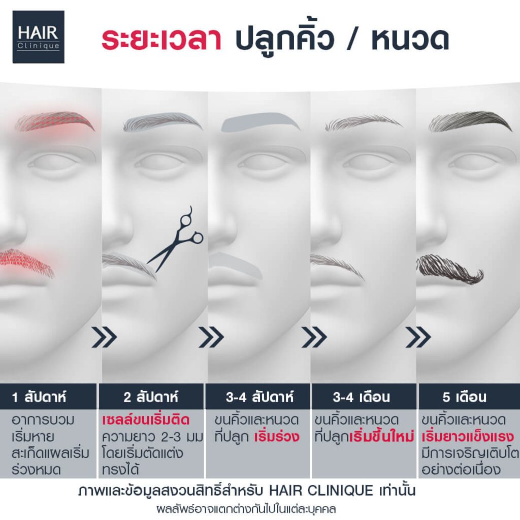 หลังปลูกคิ้วปลูกหนวด นานเท่าไหร่จึงเห็นผล