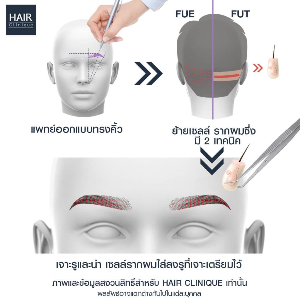ขั้นตอนการปลูกคิ้วปลูกหนวด
