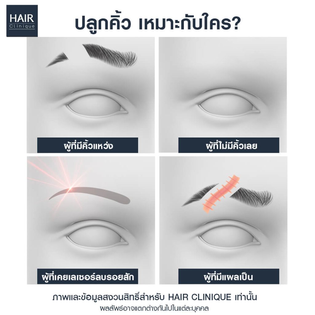 การปลูกคิ้ว เหมาะกับใครบ้าง?