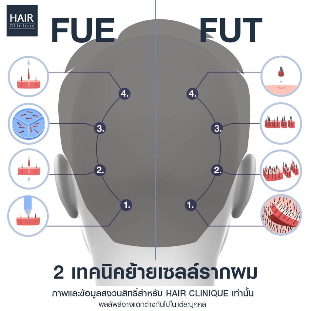 2 เทคนิคการย้ายเซลล์รากผม