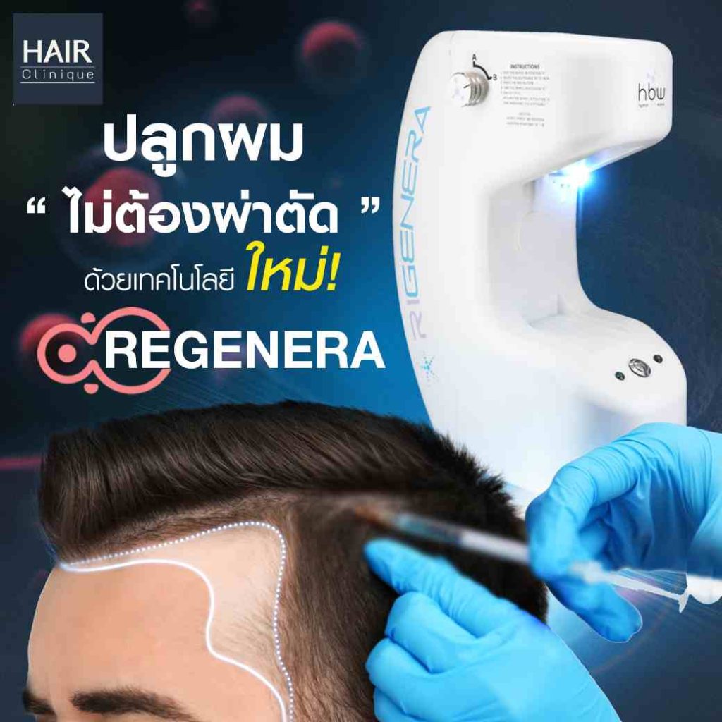 เลิกร่วง เลิกล้าน! ด้วย Regenera activa ปลูกผมไม่ต้องผ่าตัด

