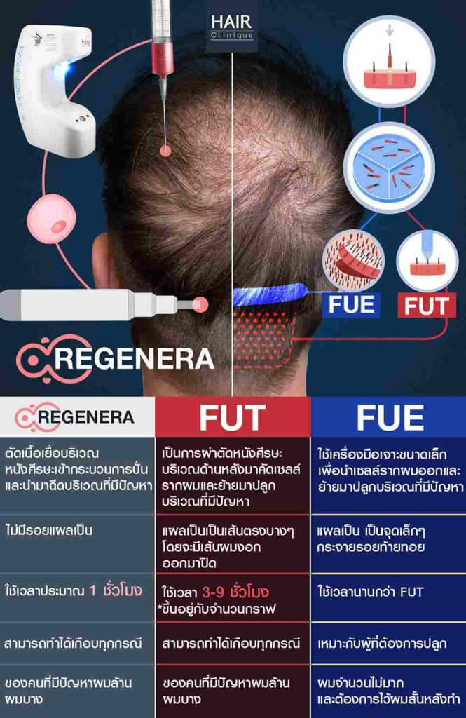 ความแตกต่างของการปลูกผม