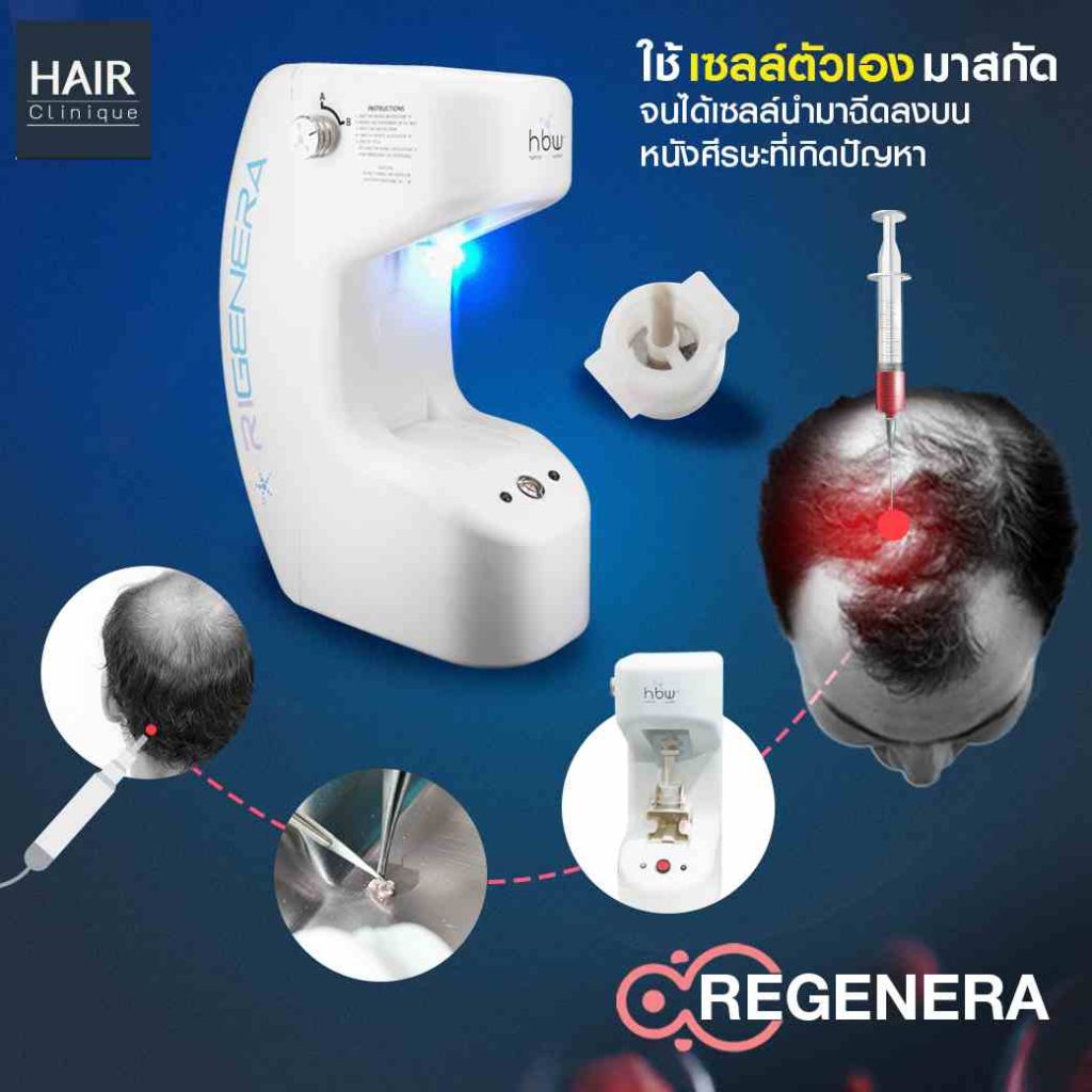 ขั้นตอนการปลูกผม Regenera activa
