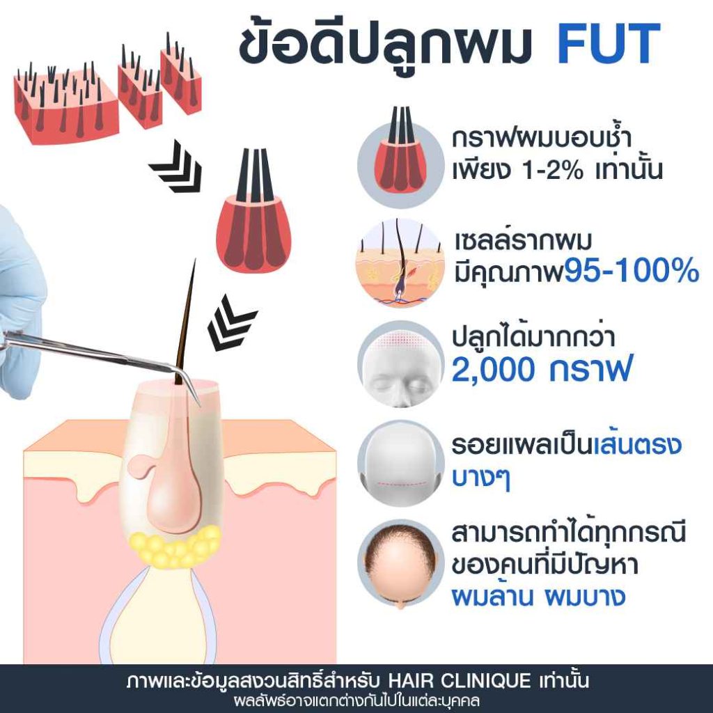 ข้อดีปลูกผม FUT